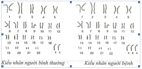 Từ sơ đồ kiểu nhân sau. Hãy cho biết bệnh nhân này mắc bệnh  (ảnh 1)